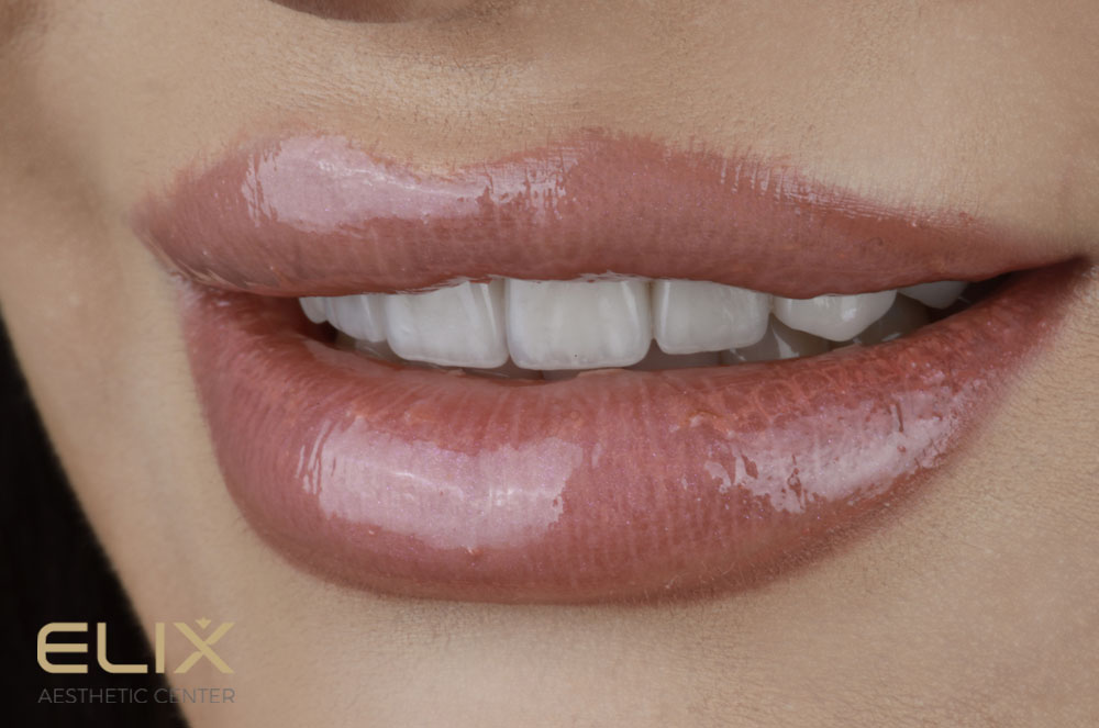 Veneers